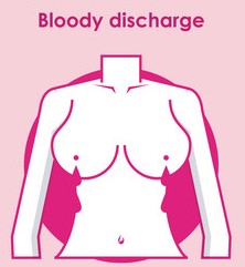 Bloody Discharge